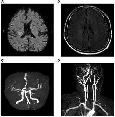 Case Report: Hypereosinophilic syndrome vs. patent foramen ovale as etiopathogenetic contributors to stroke